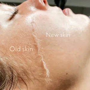 Dermaplaning Facial